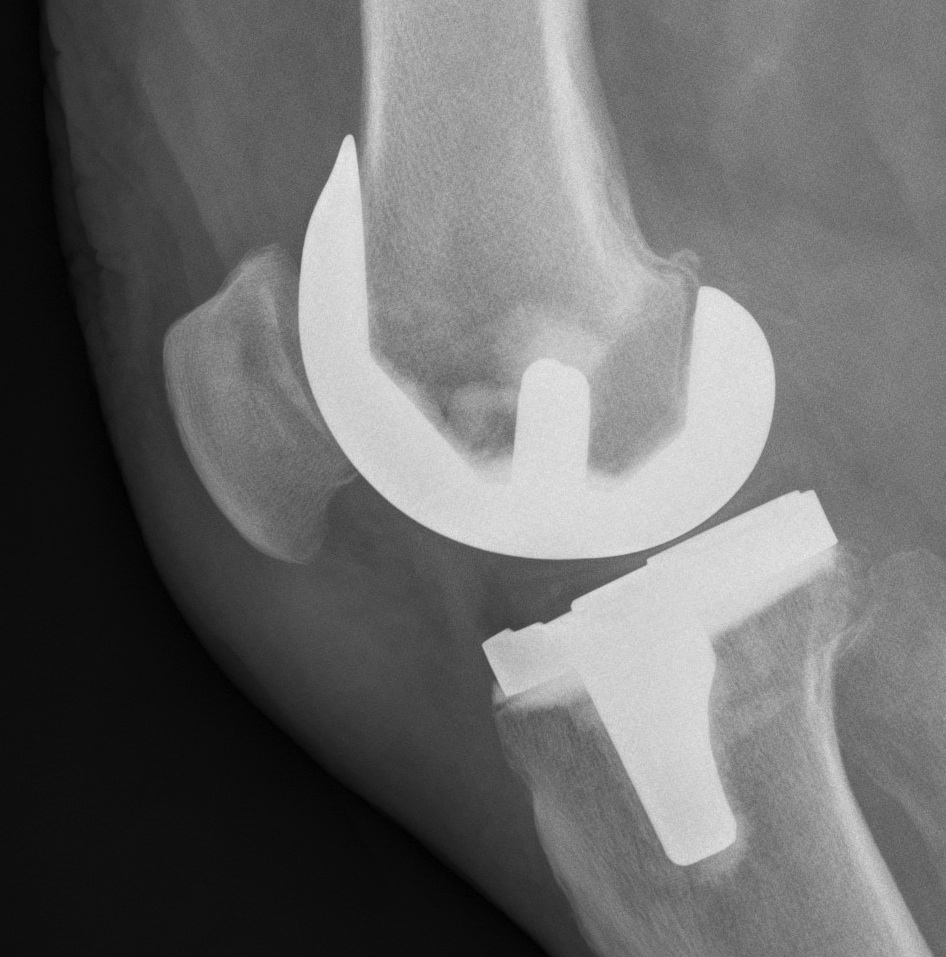 TKR Non Resurfaced Patella